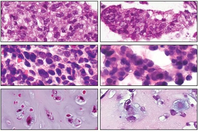 Innovative Approaches to Personalized Sarcoma Treatment and Care